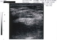 Nervus medianus im Ultraschall nach Verletzung